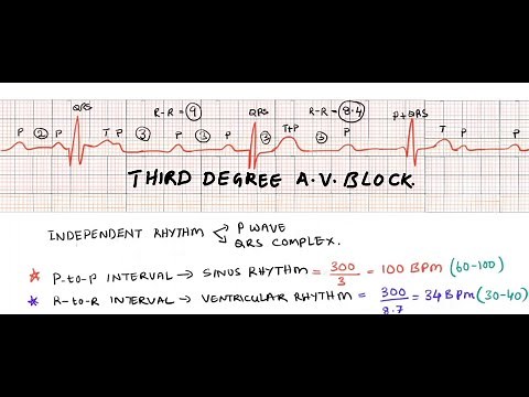 Third degree heart block/ complete A V block/ ECG interpretation of complete heart block