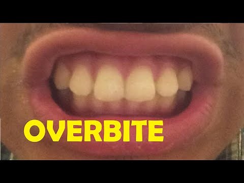 how to fix an overbite without braces