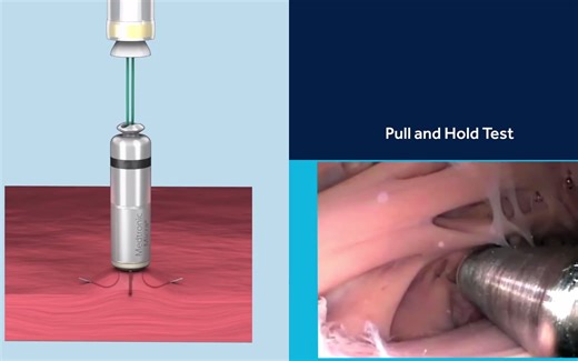 Micra TPS Implant Procedure Animation | 胶囊起搏器植入操作 无声