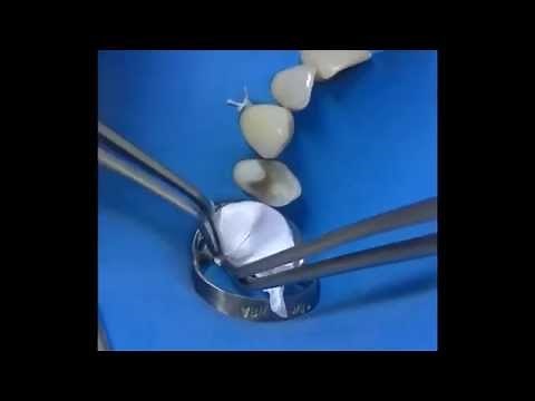 Ceramic Onlay Adhesive Cementation: Silanization