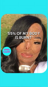 21K views · 511 reactions | Her Hair Lice Almost Killed Her Her head was engulfed in flames, causing 55% of her body to be burned at age 12. Aleema suffered 3rd-degree burns when her hair caught fire after she used a shampoo for head lice. She shares how she has navigated life as an Asian teen facing stereotypes daily. Seen Health | seen.tv | Facebook