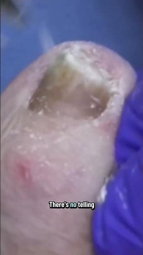 The Miracle Patient Warts Vanish Without a Trace
