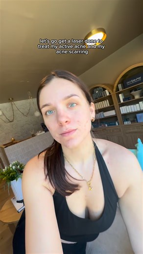 ALEXI MCKINLEY on Instagram: "Bye bye scars 👋🏼😍 Active acne laser: @aerolase Acne scarring laser: @auraluxlaser #acneskin #acnetreatment #scartreatment #cysticacne #everettwa"
