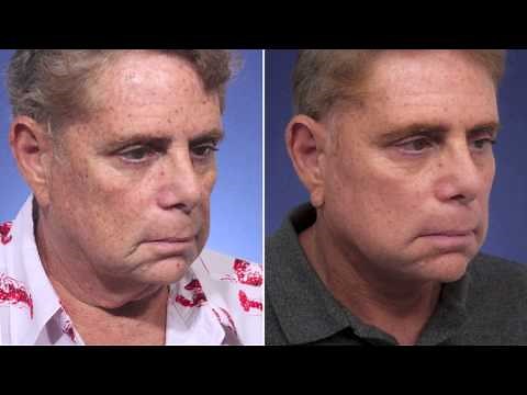 Removal of Hanging "Turkey" Neck in a Man | Review of Dr. Steiger