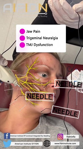 Understanding Trigeminal Neuralgia: Causes and Pathophysiology