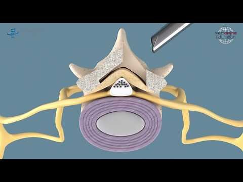 Spinal Stenosis - Full-endoscopic decompression at the lumbar spine with VERTEBRIS stenosis