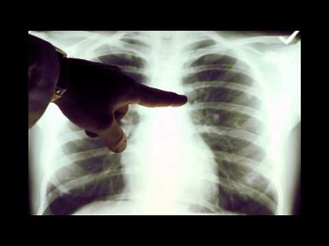 Lung Cancer X-ray