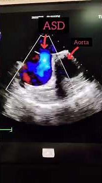 ASD in 2D Echo | Left to Right Shunt Explained Clearly ❤️🫀