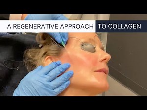 PDO Thread Lift, the Ultimate Non-Surgical Facelift