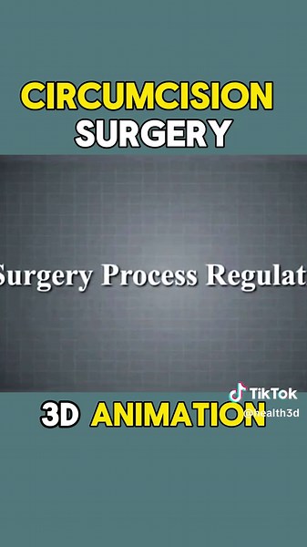 Circumcision Surgery 3d animation procedure #circumcisionsurgery #circumcisionsurgeryclinic #circumcision #zsrcircumcision #aftercircumcisionsurgery #surgery #surgery #maletofemale #medical #medicalanimation