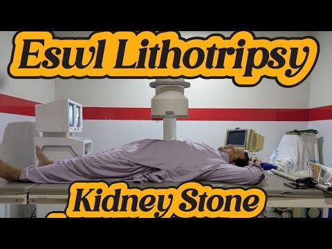 Kidney Stone ESWL Lithotripsy | working of ESWL Lithotripsy | Kidney Stone Laser Operation Treatment