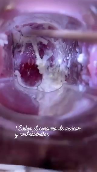 Thick, white “cottage cheese” dischargeIntense vulvar itching Usually no foul odorVaginal pH remains normal What's your diagnosis 😳❓