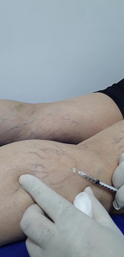 48K views · 783 reactions | Traitement des varices par injection de mousse sclérosante Dr Bada Chirurgien Cardio vasculaire Clinique CMC Kouba Alger Tel 0560161722 | Docteur Bada chirurgien Cardio Vasculaire | Facebook
