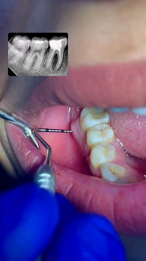 (っ◔◡◔)っ🦷 DR .KNOWLEDGE 🧠 on Instagram: "Chronic Apical Abscess is an inflammatory reaction to pulpal infection and necrosis characterized by gradual onset, little or no discomfort and an intermittent discharge of pus through an associated sinus tract. Radiographically, there are typically signs of osseous destruction such as a radiolucency. Reposted @dr_essam_shaker . . . . . . . . . . . . #dentalassistant #dentalimplants #dentalhygiene #endodontics #kanaltedavisi #endodonticspeciality #dental