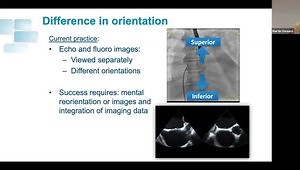TEE Guidance for Transseptal Puncture