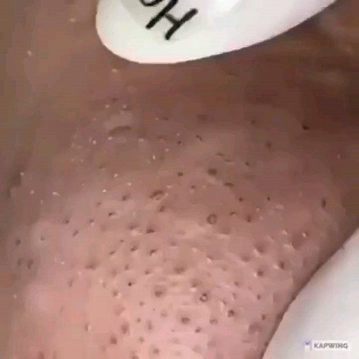 Pimple Popping 2021 on Instagram: "Follow us  @popmypimple2022 for more pimple popping videos #pores #acne #skincare #blackheads #pimples #whiteheads #pimple #blackhead #skin #beauty #blackheadextraction #blackheadremoval #pimplepopping #whitehead #pimplepop #pimplepoppers"