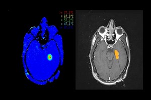 Healthy Living: Laser Ablation for Epilepsy