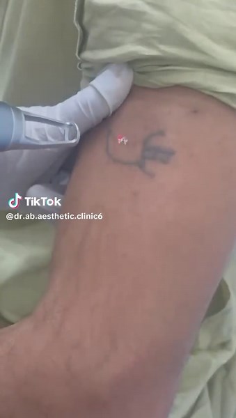 Tattoo Removal Laser Techniques Explained