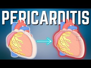 Pericarditis Aguda Explicada Claramente