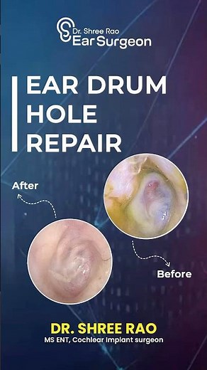 Ear drum hole repair|Dr.Shree Rao|Dr.Rao’s ENT #bestenthospital