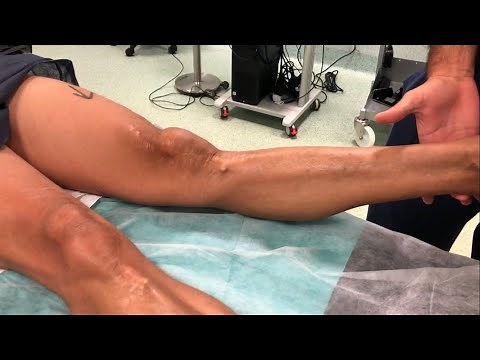 Recurvatum Knee