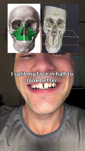 Facegenics midface expander #fme #ortho #marpe