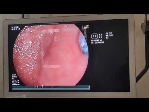 4y Fch swollwed hair clip. Endoscopy Foreign Body Removed by Dr Kiswanth sir@#Awareness#shortsfeed