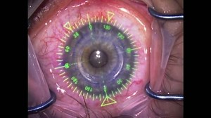 Intracorneal Ring Segments Using Verion system - Eyetube
