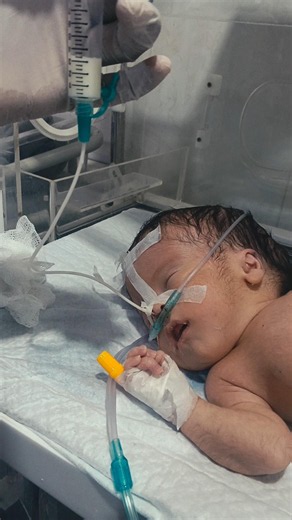 Newborn Baby NG Tube Feeding & Oxygen Support Care in NICU | Neonatal Nursing Care #nicu #baby