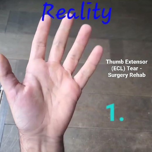Extensor Tendon Tear - Surgery Rehab - Thumb #tendon #tear #surgery #rehab #recovery