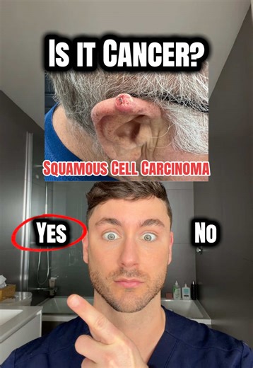 Is that skin cancer on your ear? 👂 Hear this… things can get eerie 👀 👉 1 — Basal cell carcinoma A shiny, pearly bump… and yes, a skin cancer. 👉 2 — Chondrodermatitis nodularis helicis A painful, crusted spot on the ear… but benign and related to pressure. 👉 3 — Squamous cell carcinoma A rough, scaly or crusted lesion… and a more aggressive skin cancer. 💡 The ear gets a lot of sun — and a lot of surprises. Some spots look scary but aren’t… And others don’t look like much, but are. Don’t tru