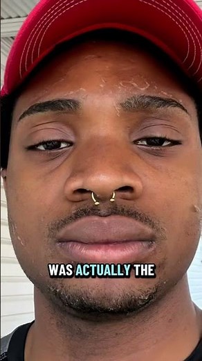 Day 5 of My VI Peel - Two-Tone Transformation Happening!