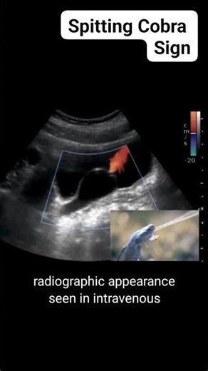 IVU in ultrasound