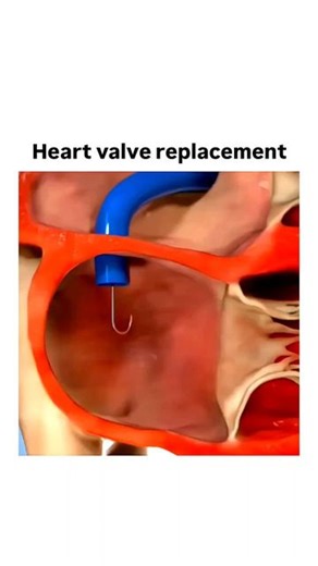World of Biology on Instagram: "Heart valve replacement 👇 Heart valve replacement is a surgical procedure where a diseased or damaged heart valve is replaced with a new one, either biological (made from animal tissue or human donor valves) or mechanical (made from artificial materials). The heart has four valves that control blood flow: 1. Mitral valve 2. Tricuspid valve 3. Aortic valve 4. Pulmonary valve Valve replacement is usually done to treat conditions like: - Stenosis (narrowing) - Regur
