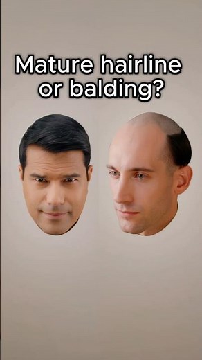 Mature hairline or balding? #hairfacts #haircare #hairloss #skincare #hairmyths #hair #menshealth
