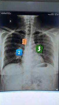 The 1-2-3 Sign: Is it BHL or Vascular Enlargement? 🫁