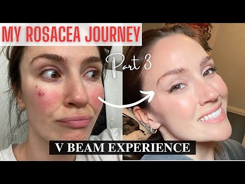ROSACEA JOURNEY PART 3 | VBEAM PERFECTA® LASER EXPERIENCE WITH DAILY PROGRESSIONAL