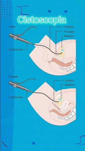 Cystoscopy - Medical Definition | Consecutive Interpretation