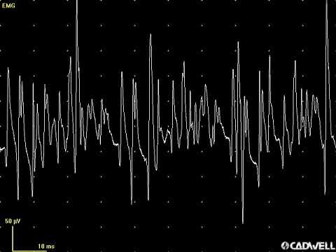 EMG teaching video 13: Additional CRD examples.