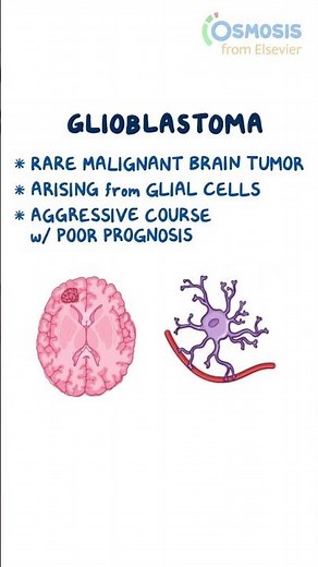 Glioblastoma