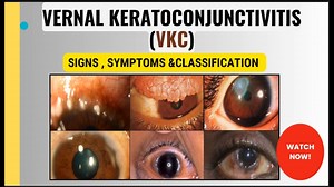 Vernal Keratoconjunctivitis (VKC)  - 春季性角结膜炎