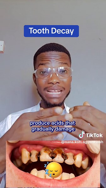 Causes of Tooth Decay: Symptoms, Prevention, and Treatment