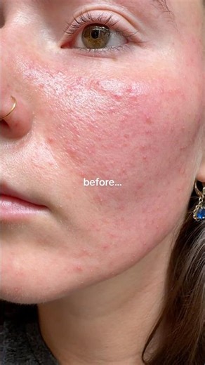 How I manage / treat my rosacea