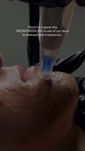 HERE’S WHY👇🏼 Micro-needling directly stimulates your skin to produce new collagen and elastin by targeting the fibroblast cells. These cells are responsible for collagen production. This is how we improve the strength, structure and quality of the skin and is the best and safest way to do so. If you want to reverse ageing and or prevent collagen loss within your skin - you NEED to be incorporating skin needling into your monthly routine. Trust us, it’s a game changer. PROVEN CLINICAL RESULTS F