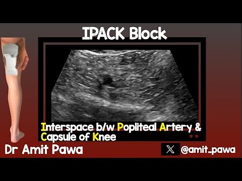 IPACK (Interspace between Popliteal Artery and Capsule of the Knee)