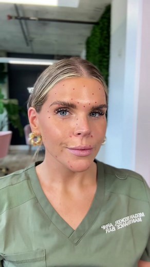 Areas to Get Botox on Your Face and What They Do