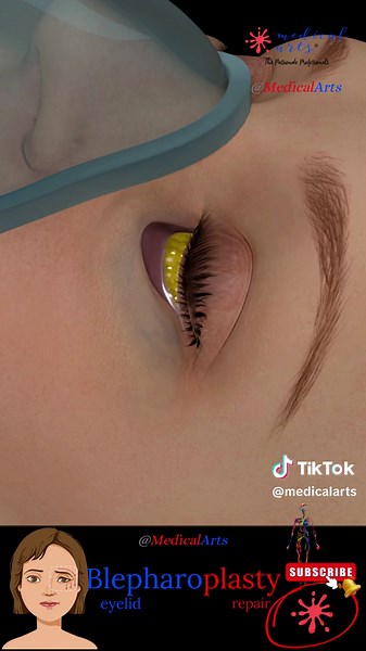 #blepharoplasty #eyelidsurgery #eyelidlift Eyelid Surgery 👁️ BlepharoPlasty 😷 MEDICAL ARTS ANIMATION Blepharoplasty, or eyelid surgery, is a specialized procedure to enhance the appearance of the eyelids. This surgical technique can be applied to the upper, lower, or both, addressing concerns such as aging signs, puffiness, and even vision impairment caused by overhanging skin. Blepharoplasty stands out in cosmetic surgery for its ability to rejuvenate the facial appearance, offering a refresh
