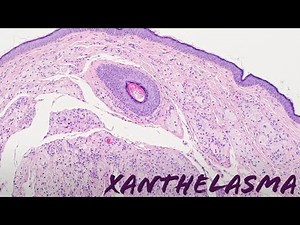 Xanthelasma (xanthoma of eyelid, yellow bumps around eye) pathology dermpath dermatology