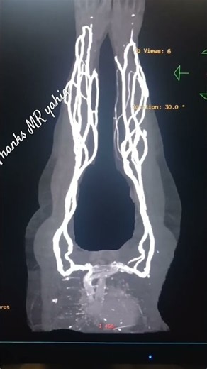 #GE 128 slices. #CT # Venography. Both upper limb. # medical