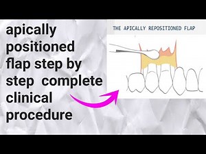 Apically positioned flap complete procedure